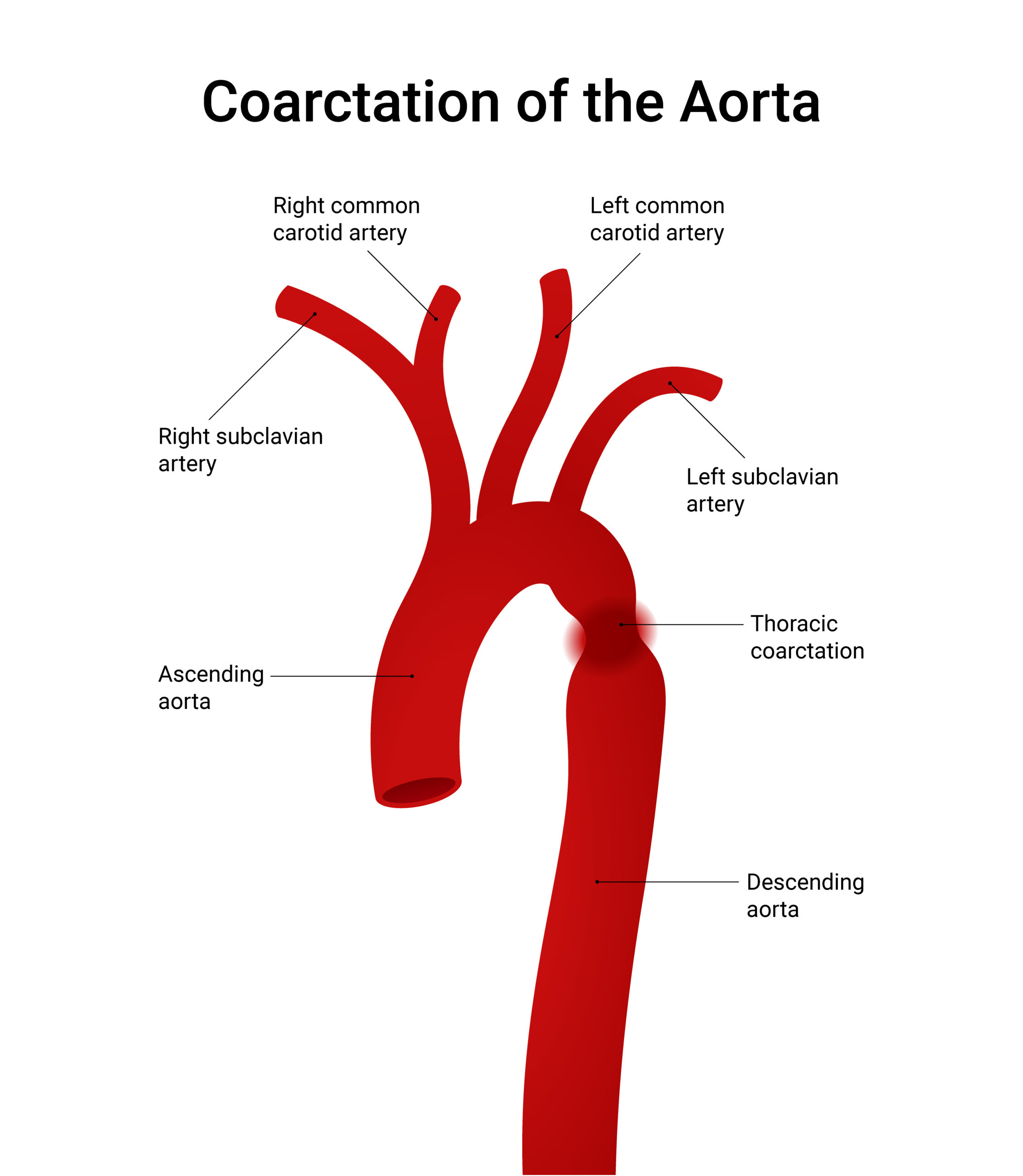 A coarctação da aorta é uma condição congênita, presente desde o nascimento, em que há um estreitamento de uma parte da aorta, que é a principal artéria responsável por levar o sangue do coração para o restante do corpo. (Imagem: Freepik)