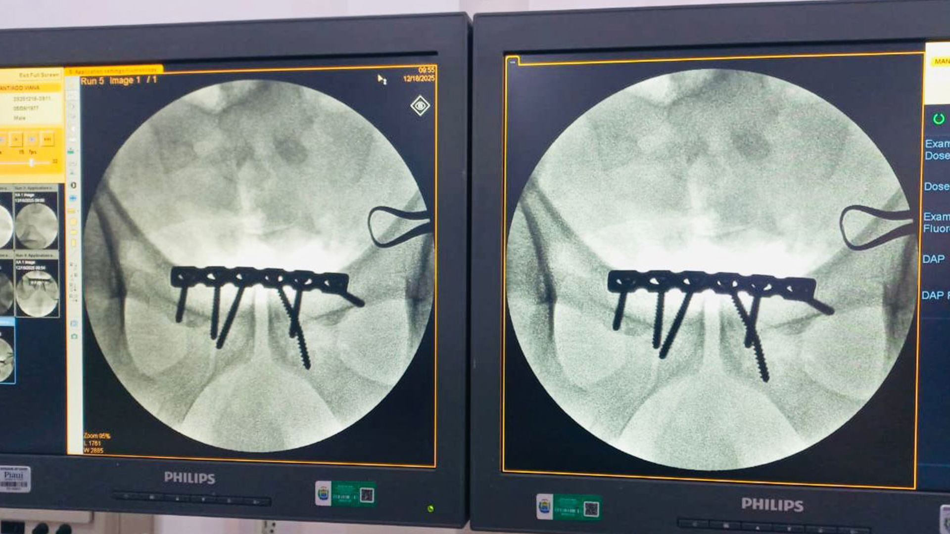 Até então, a cirurgia de fratura da bacia ou anel pélvico exigia que o paciente se deslocasse para Teresina. Agora, casos como esse podem ser tratados no HRCR. (Foto: Divulgação)